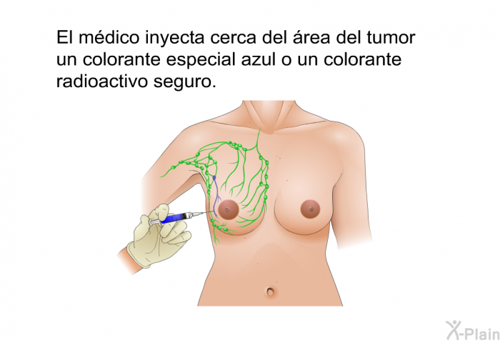 El mdico inyecta cerca del rea del tumor un colorante especial azul o un colorante radioactivo seguro.