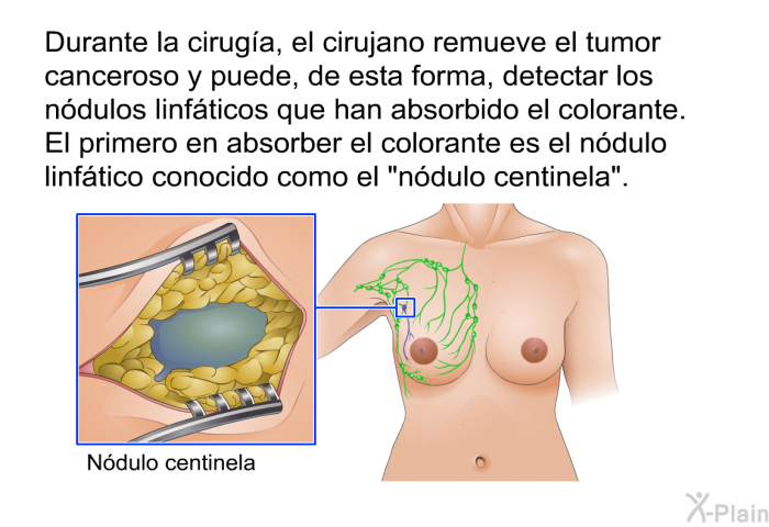 Durante la ciruga, el cirujano remueve el tumor canceroso y puede, de esta forma, detectar los ndulos linfticos que han absorbido el colorante. El primero en absorber el colorante es el ndulo linftico conocido como el “ndulo centinela”.