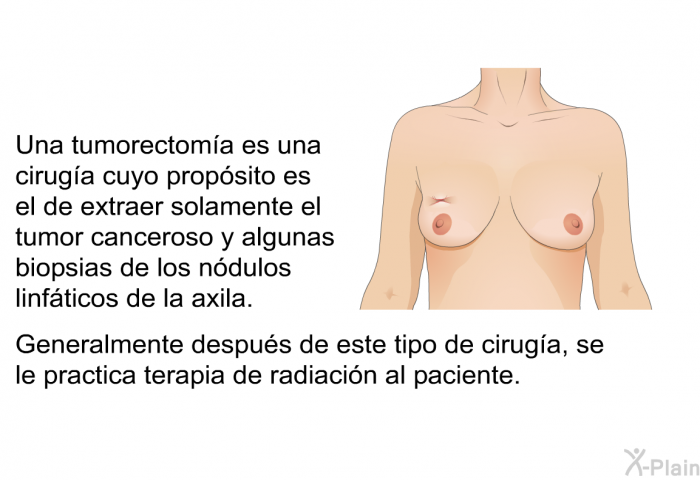 Una tumorectoma es una ciruga cuyo propsito es el de extraer solamente el tumor canceroso y algunas biopsias de los ndulos linfticos de la axila. Generalmente despus de este tipo de ciruga, se le practica terapia de radiacin al paciente.