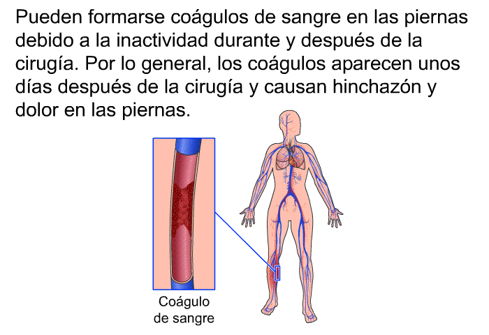 Pueden formarse co�gulos de sangre en las piernas debido a la inactividad durante y despu�s de la cirug�a. Por lo general, los co�gulos aparecen unos d�as despu�s de la cirug�a y causan hinchaz�n y dolor en las piernas.