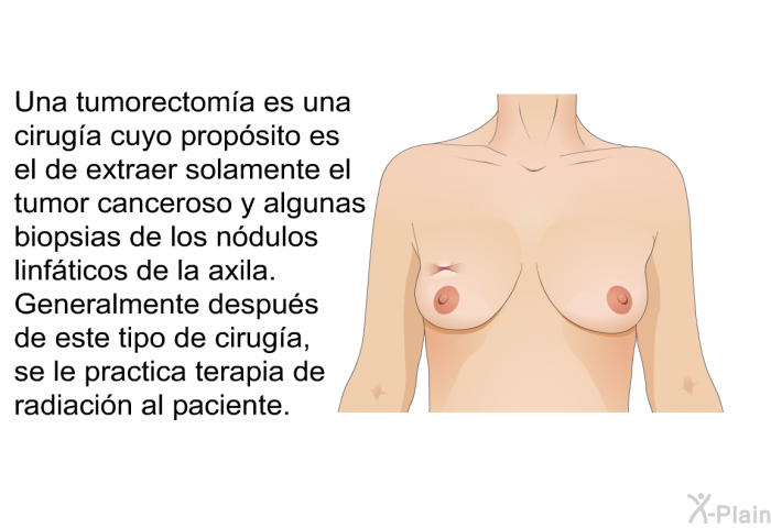 Una tumorectom�a es una cirug�a cuyo prop�sito es el de extraer solamente el tumor canceroso y algunas biopsias de los n�dulos linf�ticos de la axila. Generalmente despu�s de este tipo de cirug�a, se le practica terapia de radiaci�n al paciente.