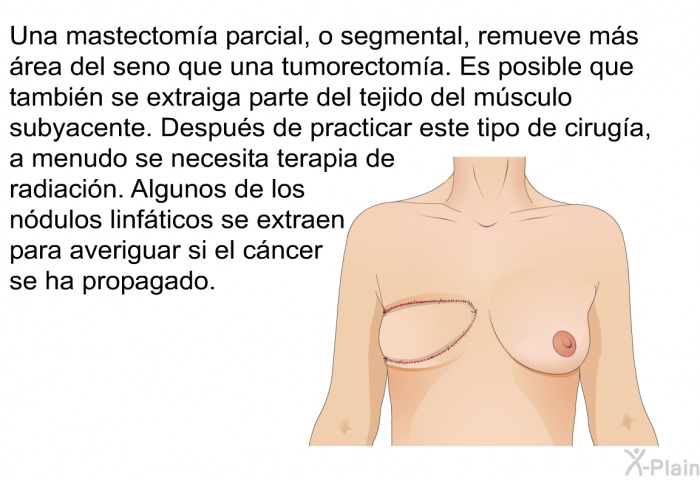 Una mastectom�a parcial, o segmental, remueve m�s �rea del seno que una tumorectom�a. Es posible que tambi�n se extraiga parte del tejido del m�sculo subyacente. Despu�s de practicar este tipo de cirug�a, a menudo se necesita terapia de radiaci�n. Algunos de los n�dulos linf�ticos se extraen para averiguar si el c�ncer se ha propagado.