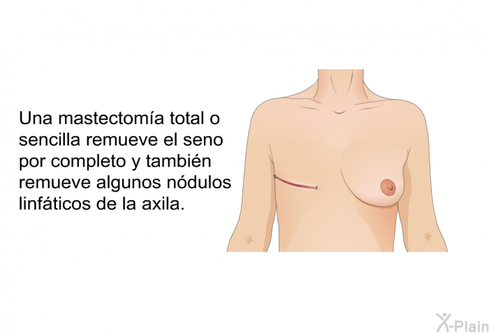 Una mastectom�a total o sencilla remueve el seno por completo y tambi�n remueve algunos n�dulos linf�ticos de la axila.