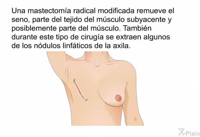 Una mastectom�a radical modificada remueve el seno, parte del tejido del m�sculo subyacente y posiblemente parte del m�sculo. Tambi�n durante este tipo de cirug�a se extraen algunos de los n�dulos linf�ticos de la axila.