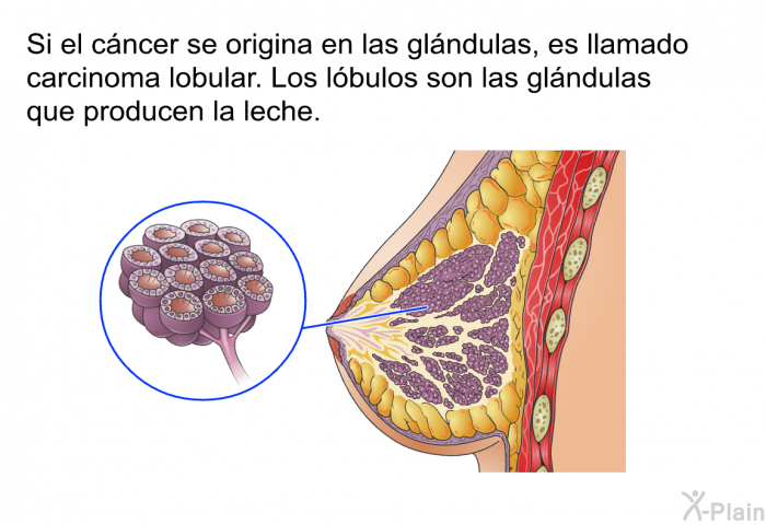 Si el cncer se origina en las glndulas, es llamado carcinoma lobular. Los lbulos son las glndulas que producen la leche.