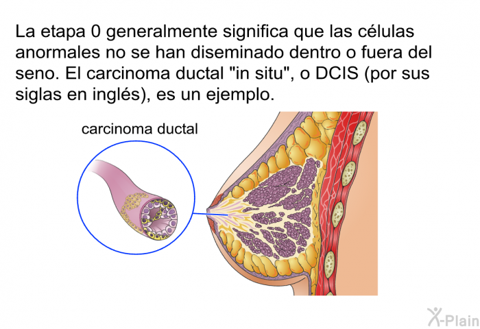 La etapa 0 generalmente significa que las clulas anormales no se han diseminado dentro o fuera del seno. El carcinoma ductal “in situ<I>”</I>, o DCIS (por sus siglas en ingls), es un ejemplo.