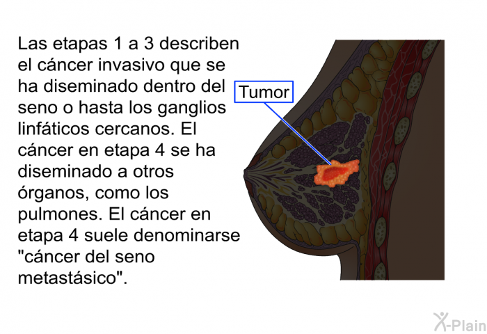 Las etapas 1 a 3 describen el cncer invasivo que se ha diseminado dentro del seno o hasta los ganglios linfticos cercanos. El cncer en etapa 4 se ha diseminado a otros rganos, como los pulmones. El cncer en etapa 4 suele denominarse “cncer del seno metastsico”.