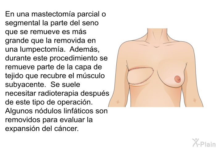 En una mastectoma parcial o segmental la parte del seno que se remueve es ms grande que la removida en una lumpectoma. Adems, durante este procedimiento se remueve parte de la capa de tejido que recubre el msculo subyacente. Se suele necesitar radioterapia despus de este tipo de operacin. Algunos ndulos linfticos son removidos para evaluar la expansin del cncer.