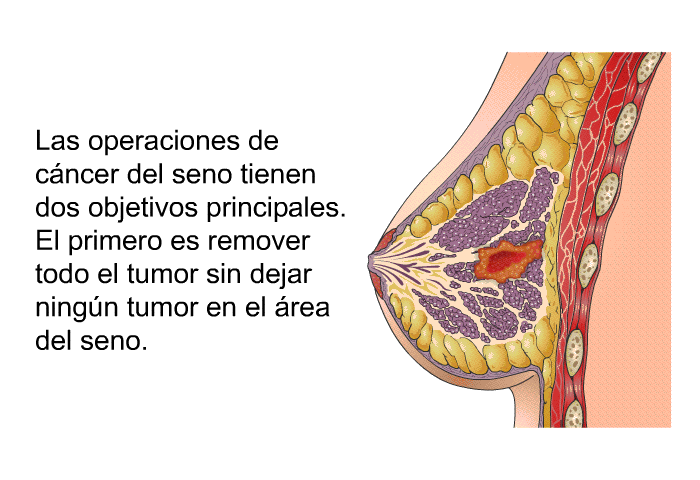 Las operaciones de cncer del seno tienen dos objetivos principales. El primero es remover todo el tumor sin dejar ningn tumor en el rea del seno.
