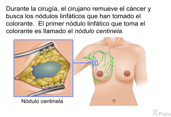 Durante la ciruga, el cirujano remueve el cncer y busca los ndulos linfticos que han tomado el colorante. El primer ndulo linftico que toma el colorante es llamado el ndulo centinela.