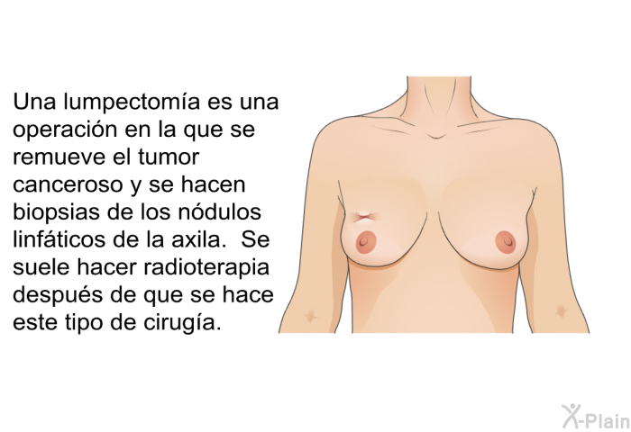 Una lumpectoma es una operacin en la que se remueve el tumor canceroso y se hacen biopsias de los ndulos linfticos de la axila. Se suele hacer radioterapia despus de que se hace este tipo de ciruga.
