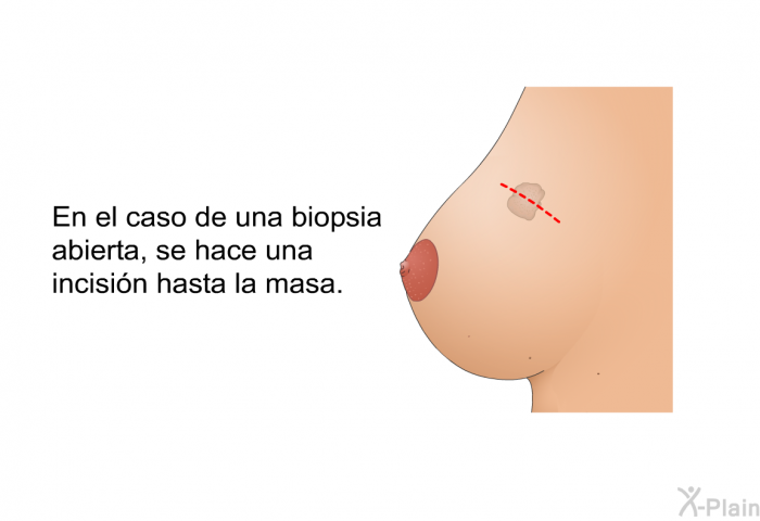 En el caso de una biopsia abierta, se hace una incisin hasta la masa.