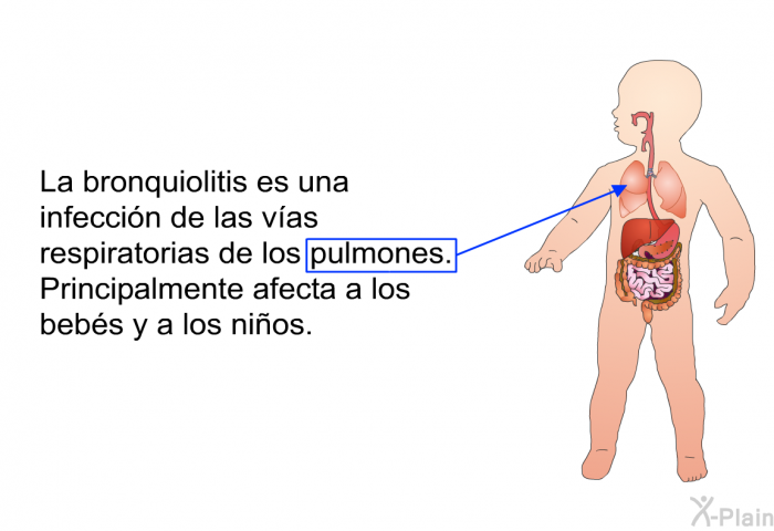 La bronquiolitis es una infeccin de las vas respiratorias de los pulmones. Principalmente afecta a los bebs y a los nios.