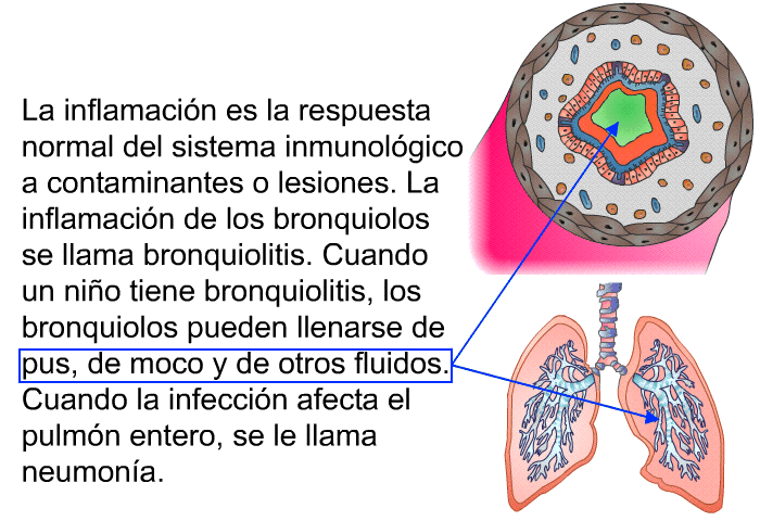 La inflamacin es la respuesta normal del sistema inmunolgico a contaminantes o lesiones. La inflamacin de los bronquiolos se llama bronquiolitis. Cuando un nio tiene bronquiolitis, los bronquiolos pueden llenarse de pus, de moco y de otros fluidos. Cuando la infeccin afecta el pulmn entero, se le llama neumona.