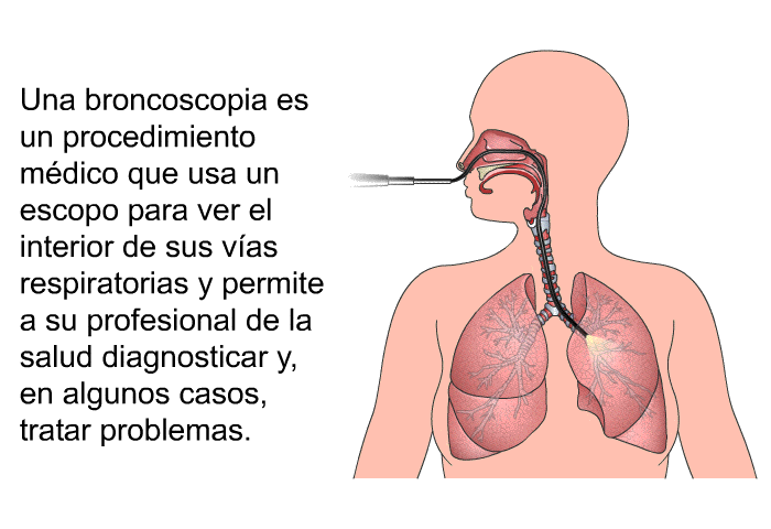 Una broncoscopia es un procedimiento mdico que usa un escopo para ver el interior de sus vas respiratorias y permite a su profesional de la salud diagnosticar y, en algunos casos, tratar problemas.