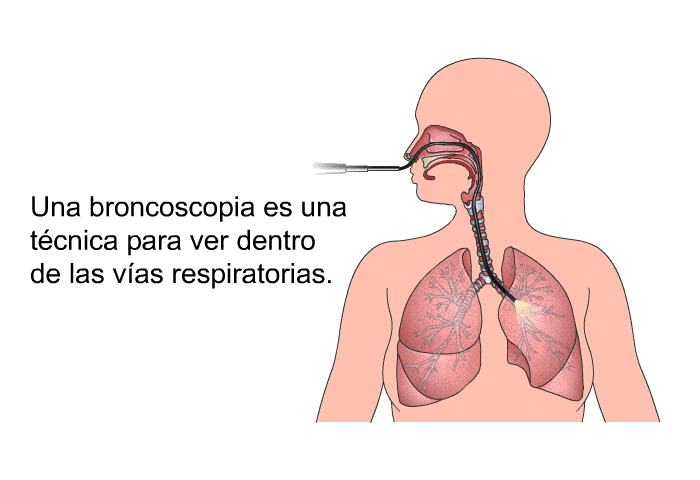 Una broncoscopia es una tcnica para ver dentro de las vas respiratorias.