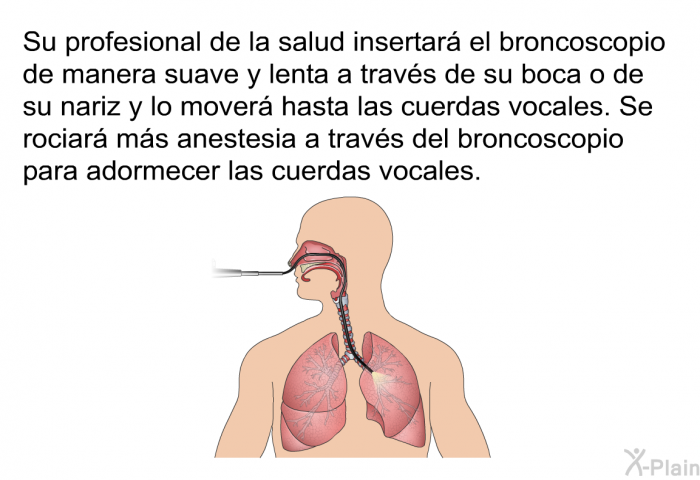Su profesional de la salud insertar el broncoscopio de manera suave y lenta a travs de su boca o de su nariz y lo mover hasta las cuerdas vocales. Se rociar ms anestesia a travs del broncoscopio para adormecer las cuerdas vocales.