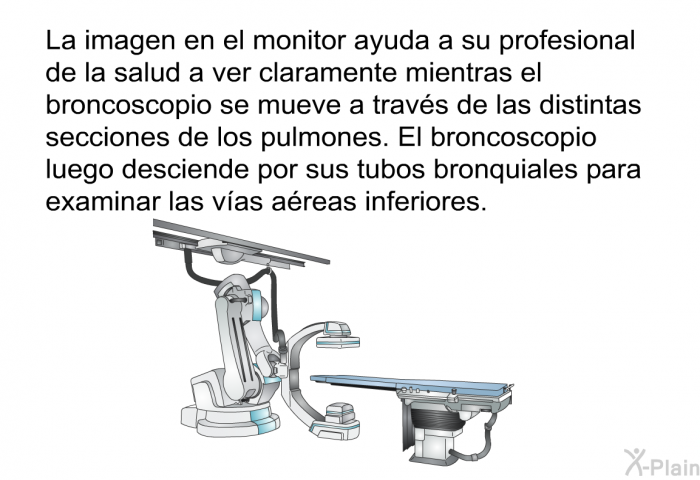 La imagen en el monitor ayuda a su profesional de la salud a ver claramente mientras el broncoscopio se mueve a travs de las distintas secciones de los pulmones. El broncoscopio luego desciende por sus tubos bronquiales para examinar las vas areas inferiores.