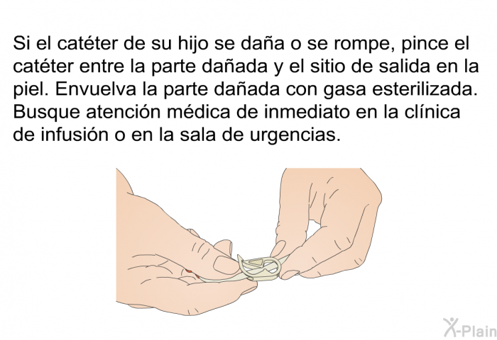 Si el catter de su hijo se daa o se rompe, pince el catter entre la parte daada y el sitio de salida en la piel. Envuelva la parte daada con gasa esterilizada. Busque atencin mdica de inmediato en la clnica de infusin o en la sala de urgencias.