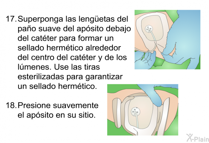 <OL START=17> Superponga las lengüetas del pao suave del apsito debajo del catter para formar un sellado hermtico alrededor del centro del catter y de los lmenes. Use las tiras esterilizadas para garantizar un sellado hermtico. Presione suavemente el apsito en su sitio.