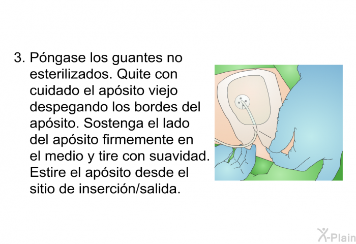 <B>Pngase los guantes no esterilizados. </B>Quite con cuidado el apsito viejo despegando los bordes del apsito. Sostenga el lado del apsito firmemente en el medio y tire con suavidad. Estire el apsito desde el sitio de insercin/salida.