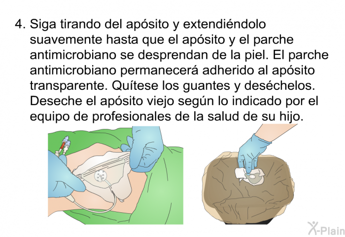 Siga tirando del apsito y extendindolo suavemente hasta que el apsito y el parche antimicrobiano se desprendan de la piel. El parche antimicrobiano permanecer adherido al apsito transparente. <B>Qutese los guantes y deschelos.</B> Deseche el apsito viejo segn lo indicado por el equipo de profesionales de la salud de su hijo.
