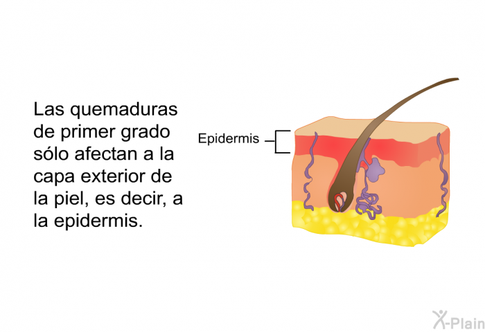 Las quemaduras de primer grado slo afectan a la capa exterior de la piel, es decir, a la epidermis.
