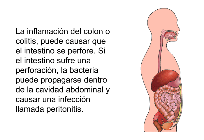 La inflamacin del colon o colitis, puede causar que el intestino se perfore. Si el intestino sufre una perforacin, la bacteria puede propagarse dentro de la cavidad abdominal y causar una infeccin llamada peritonitis.
