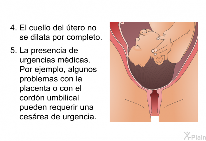 El cuello del tero no se dilata por completo. La presencia de urgencias mdicas. Por ejemplo, algunos problemas con la placenta o con el cordn umbilical pueden requerir una cesrea de urgencia.