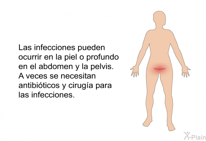 Las infecciones pueden ocurrir en la piel o profundo en el abdomen y la pelvis. A veces se necesitan antibiticos y ciruga para las infecciones.