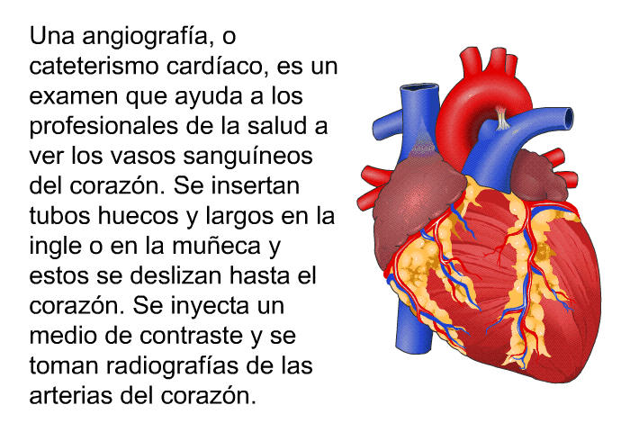 Una angiografa, o cateterismo cardaco, es un examen que ayuda a los profesionales de la salud a ver los vasos sanguneos del corazn. Se insertan tubos huecos y largos en la ingle o en la mueca y estos se deslizan hasta el corazn. Se inyecta un medio de contraste y se toman radiografas de las arterias del corazn.