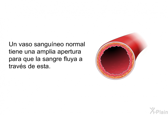 Un vaso sanguneo normal tiene una amplia apertura para que la sangre fluya a travs de esta.