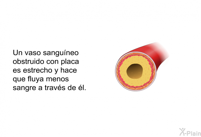 Un vaso sanguneo obstruido con placa es estrecho y hace que fluya menos sangre a travs de l.