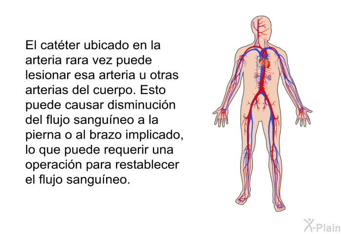 El catter ubicado en la arteria rara vez puede lesionar esa arteria u otras arterias del cuerpo. Esto puede causar disminucin del flujo sanguneo a la pierna o al brazo implicado, lo que puede requerir una operacin para restablecer el flujo sanguneo.