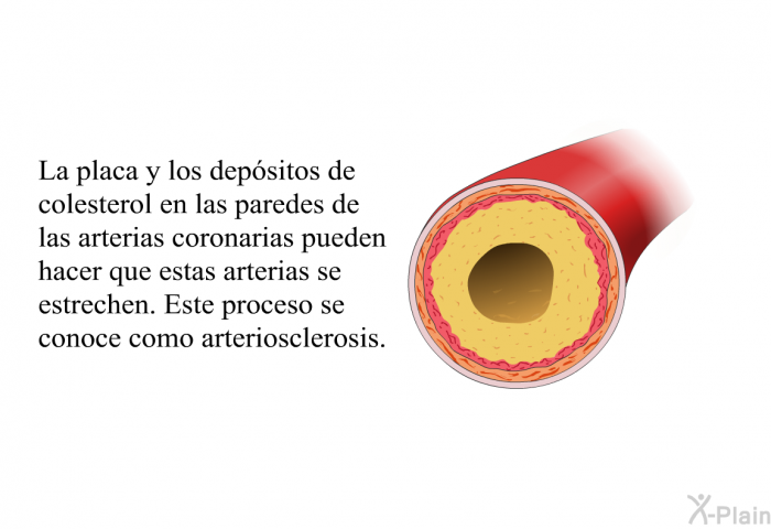 La placa y los depsitos de colesterol en las paredes de las arterias coronarias pueden hacer que estas arterias se estrechen. Este proceso se conoce como arteriosclerosis.