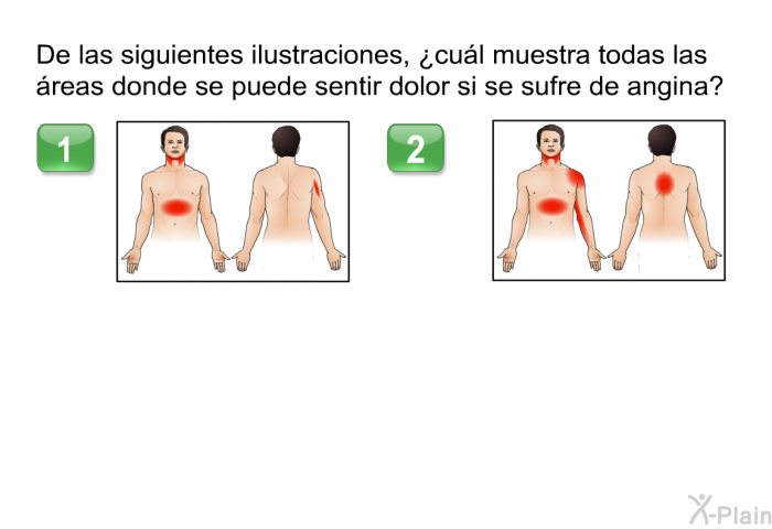 De las siguientes ilustraciones, &iquest;cu�l muestra todas las �reas donde se puede sentir dolor si se sufre de angina?
