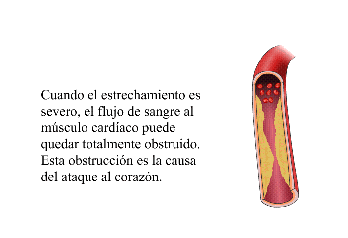 Cuando el estrechamiento es severo, el flujo de sangre al m�sculo card�aco puede quedar totalmente obstruido. Esta obstrucci�n es la causa del ataque al coraz�n.