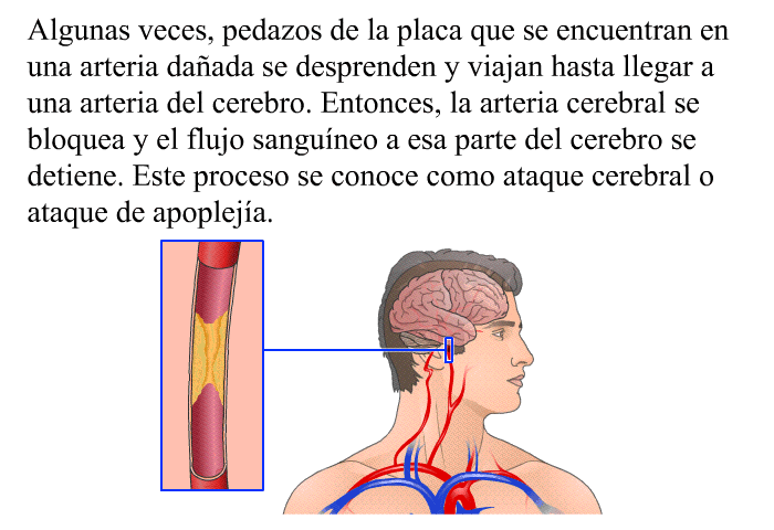 Algunas veces, pedazos de la placa que se encuentran en una arteria da�ada se desprenden y viajan hasta llegar a una arteria del cerebro. Entonces, la arteria cerebral se bloquea y el flujo sangu�neo a esa parte del cerebro se detiene. Este proceso se conoce como ataque cerebral o ataque de apoplej�a.
