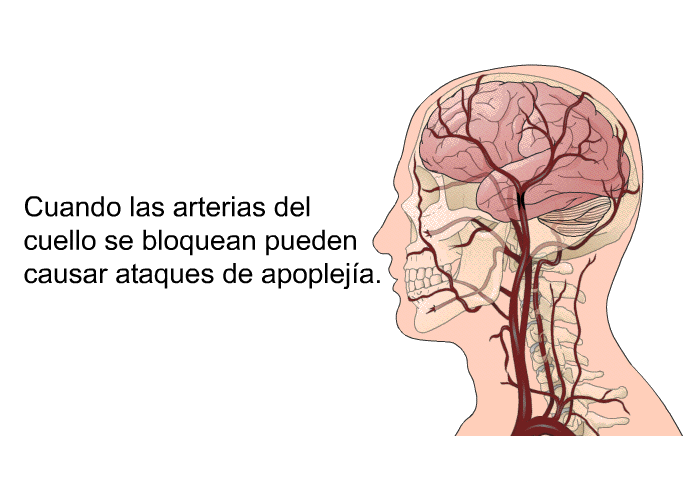 Cuando las arterias del cuello se bloquean pueden causar ataques de apopleja.