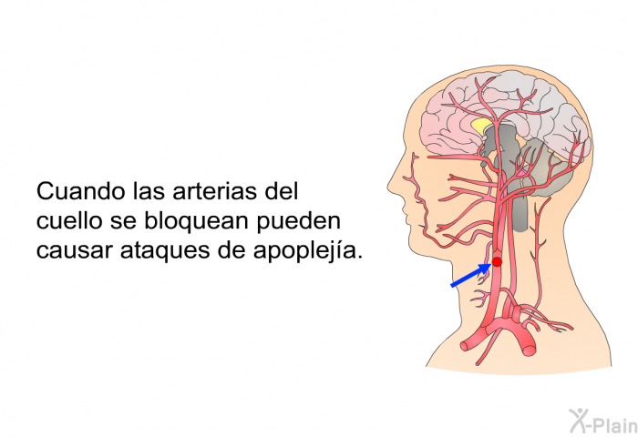 Cuando las arterias del cuello se bloquean pueden causar ataques de apopleja.