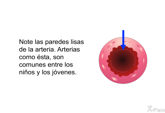 Note las paredes lisas de la arteria. Arterias como sta, son comunes entre los nios y los jvenes.