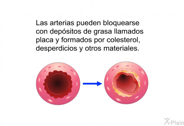 Las arterias pueden bloquearse con depsitos de grasa llamados placa y formados por colesterol, desperdicios y otros materiales.