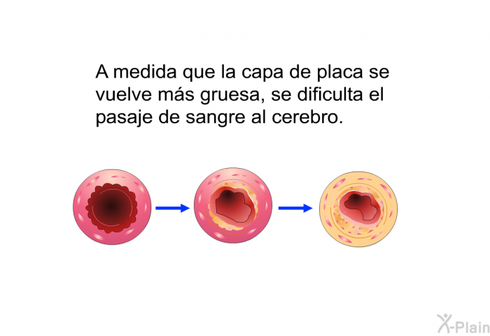 A medida que la capa de placa se vuelve ms gruesa, se dificulta el pasaje de sangre al cerebro.