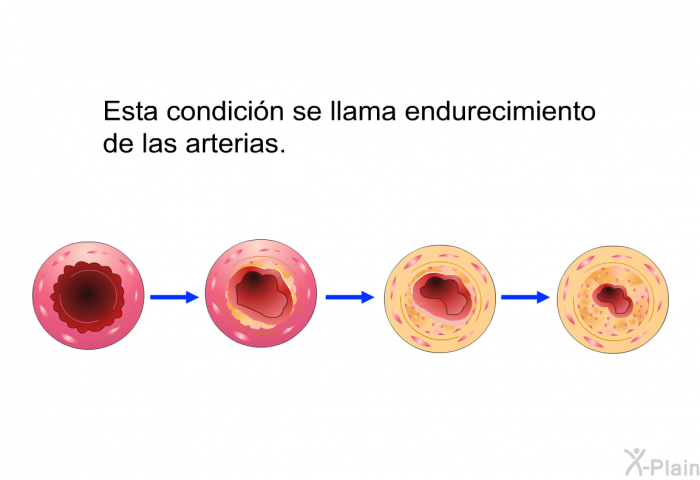 Esta condicin se llama endurecimiento de las arterias.