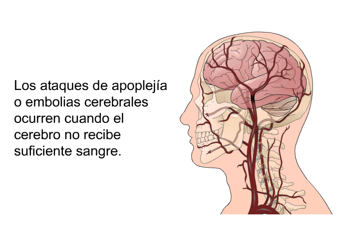 Los ataques de apopleja o embolias cerebrales ocurren cuando el cerebro no recibe suficiente sangre.