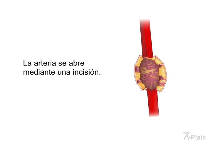 La arteria se abre mediante una incisin.