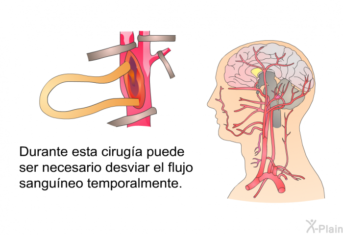 Durante esta ciruga puede ser necesario desviar el flujo sanguneo temporalmente.