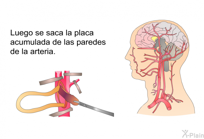 Luego se saca la placa acumulada de las paredes de la arteria.