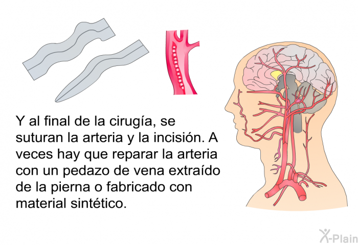 Y al final de la ciruga, se suturan la arteria y la incisin. A veces hay que reparar la arteria con un pedazo de vena extrado de la pierna o fabricado con material sinttico.