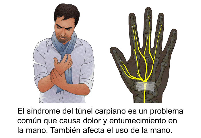 El sndrome del tnel carpiano es un problema comn que causa dolor y entumecimiento en la mano. Tambin afecta el uso de la mano.